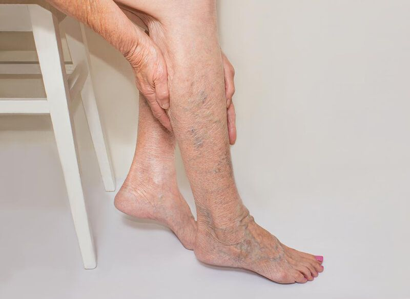 Điều trị Suy Giãn Tĩnh Mạch